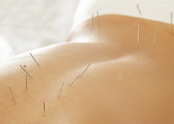Fevereiro Roxo destaca a acupuntura no cuidado integral da fibromialgia