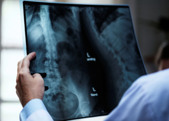 Osteoporose atinge homens e mulheres de maneira diferente; veja cuidados