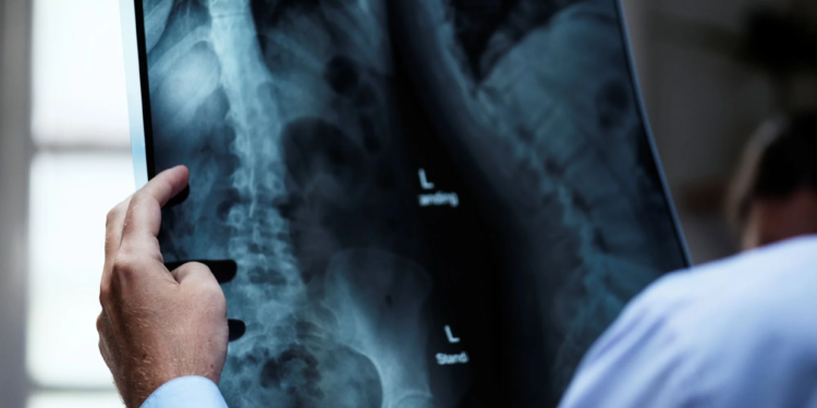 Osteoporose atinge homens e mulheres de maneira diferente; veja cuidados