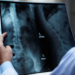 Osteoporose atinge homens e mulheres de maneira diferente; veja cuidados